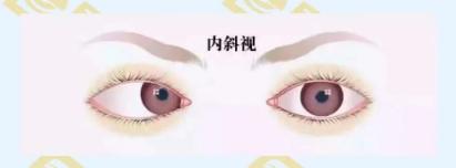 什么是調節(jié)性內斜視？
