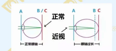 哪個(gè)年齡近視度數(shù)最容易增長？